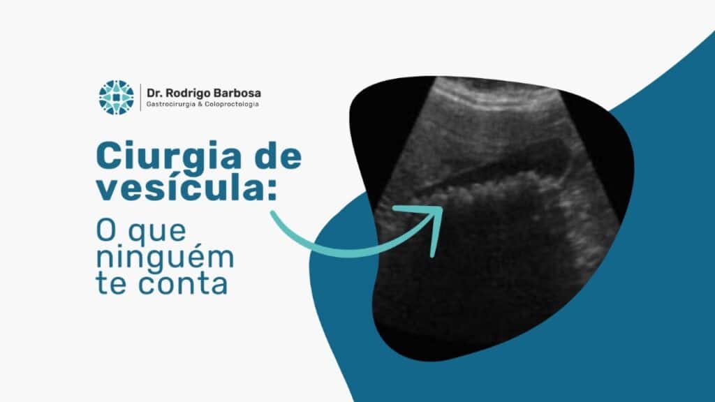Cirurgia de Vesícula (Colecistectomia) em SP: Guia Completo 1 cirurgia de vesícula (colecistectomia) guia completo em São Paulo