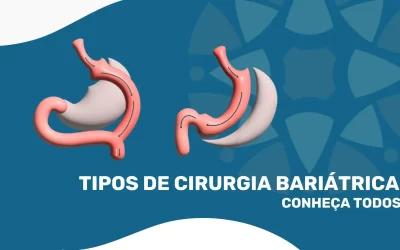 12 Tipos de Cirurgia Bariátrica: Conheça Todos