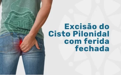 Excisão do Cisto Pilonidal com ferida fechada