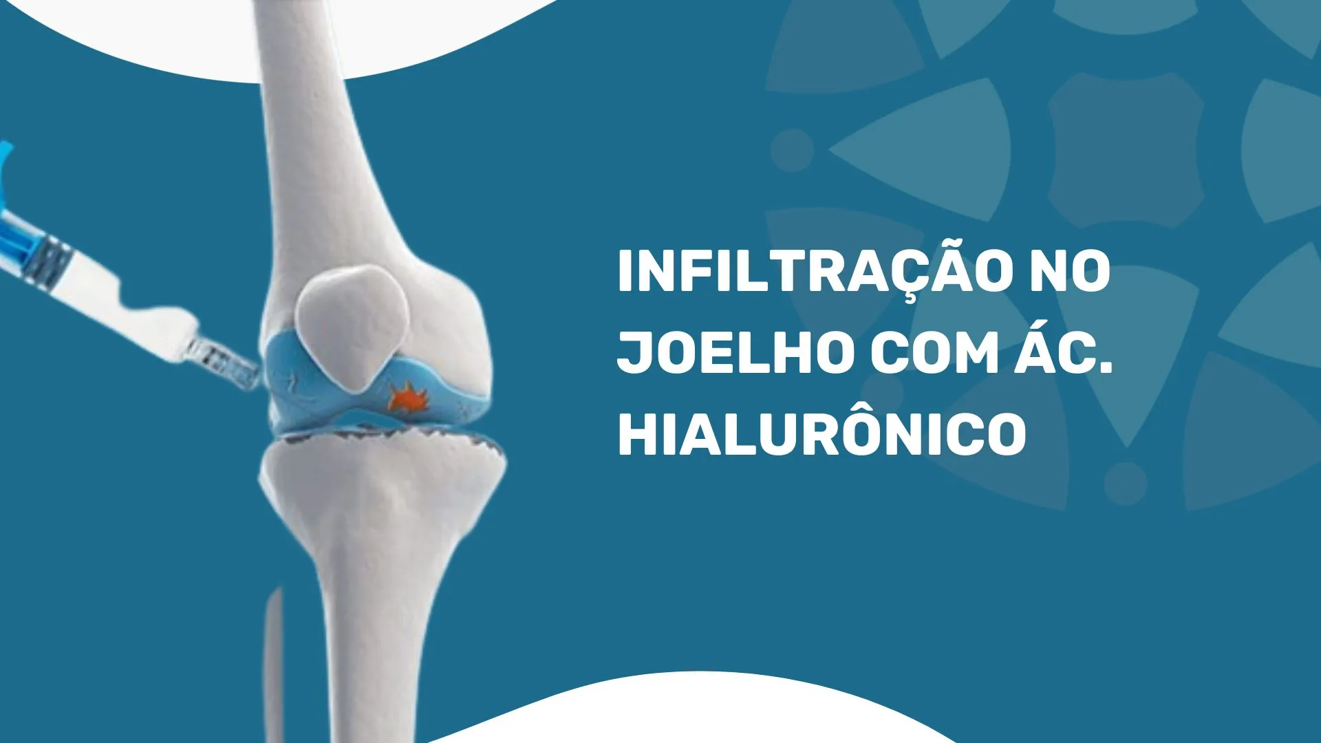 Imagem ilustrativa detalhando o valor de uma infiltração no joelho e quanto custa uma infiltração de ácido hialurônico no joelho, demonstrando a infiltração de joelho, o preço infiltração ácido hialurônico e o tratamento com ácido hialurônico no joelho, ressaltando quanto custa a infiltração de ácido hialurônico para dores no joelho, os benefícios do ácido hialurônico no tratamento de lesões de joelho e a infiltração de ácido hialurônico para recuperação de lesões esportivas no joelho.